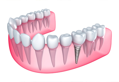 Dental Implants for Tooth Replacement in Bethesda, MD