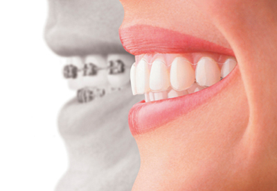 Invisalign® Clear Braces in Bethesda, MD