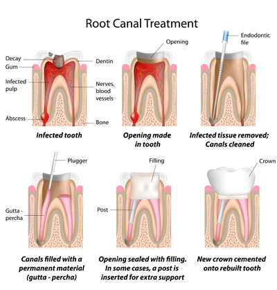 Root Canal Treatment in Bethesda, MD