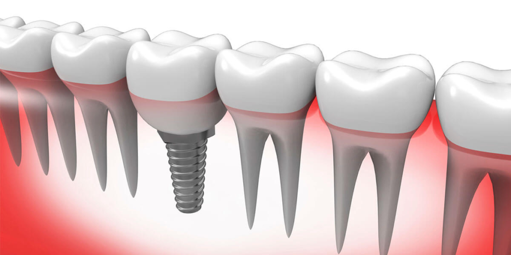 single tooth dental implants in Potomac MD