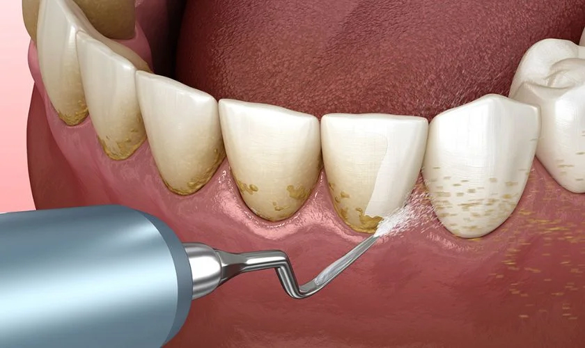 periodontal disease treatment Potomac MD