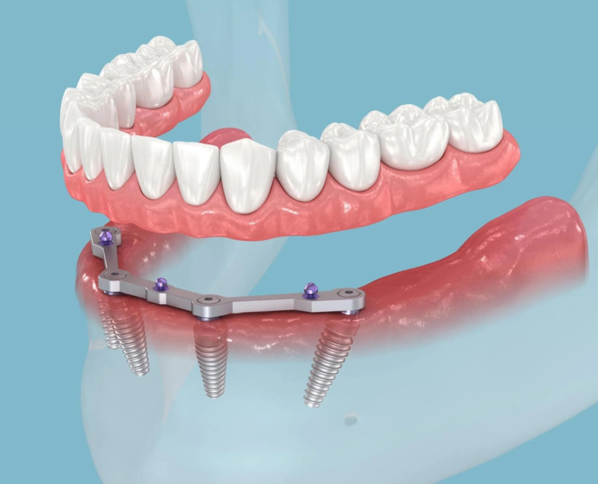 All 4s Dental Implants Potomac MD