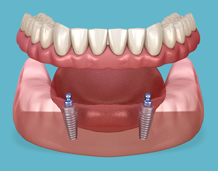 Implant secured dentures Potomac MD
