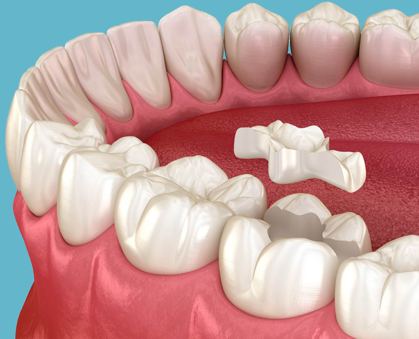 Porcelain Onlays Potomac MD