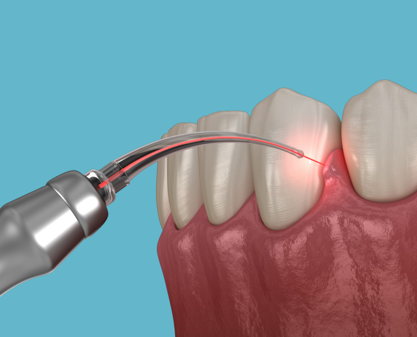 laser dentistry potomac maryland