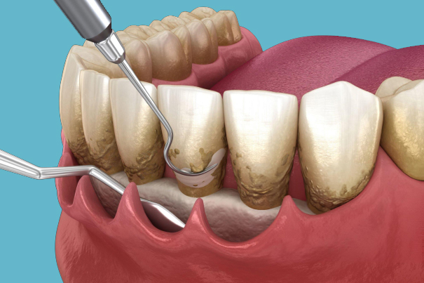periodontal surgery Potomac MD